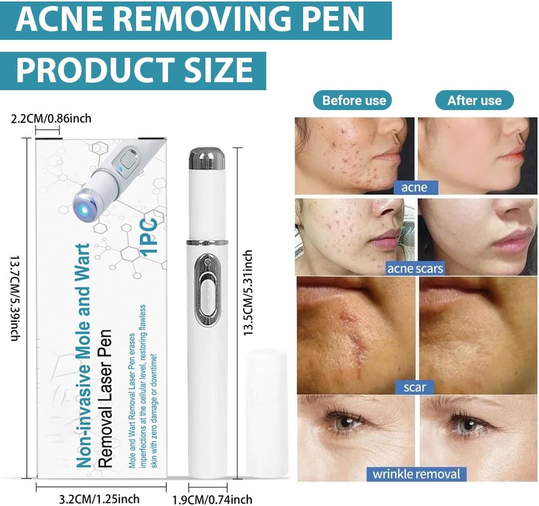 Stylo Laser Bleu : Élimination Verrues & Soins Visage – Image 2